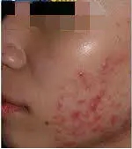 油性皮肤爱长痘 改善痘肌这样吃