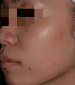 油性皮肤爱长痘 改善痘肌这样吃