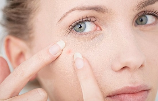 祛痘路上总踩坑，你经历过哪些？怎么正确祛痘