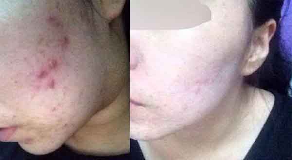 加盟美容店选对品牌很重要,为什么?祛痘连锁品牌有哪些?