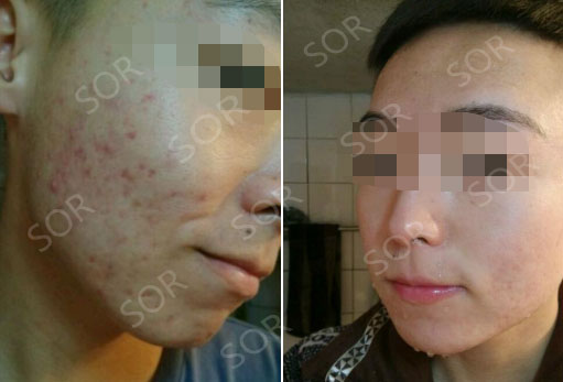 自己作出来的痘痘 付出任何代价都要治好