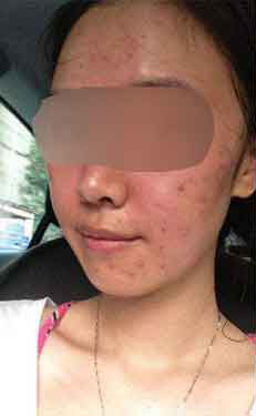 过敏泛红还长痘 如何挽救自己的肌肤