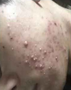 脸上长很多脓包痘痘如何治疗才能好