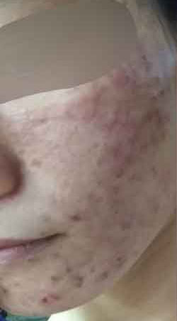 纠缠六年 我和痘痘的恩怨情仇如何化解