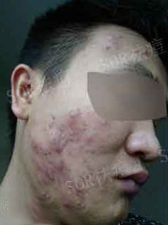成年人长痘如何彻底消除