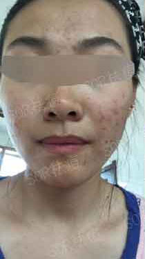 长痘2年如何快速摆脱痘痘