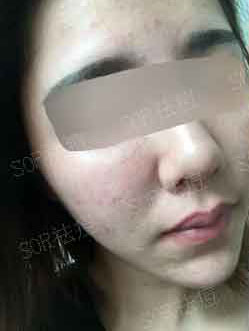 这样做 赶跑了纠缠我三年的痘痘