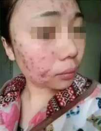 当化妆都盖不住满脸痘痘时该怎么办