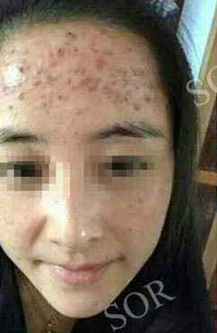长痘原因这么多你却只想挤痘痘？
