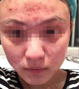长痘原因这么多你却只想挤痘痘？