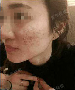长痘原因这么多你却只想挤痘痘？