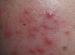 丘疹型痤疮症状分析——SOR皮肤专家为您解答