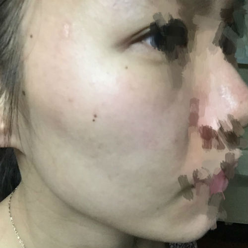 SOR祛痘让我开启新生活