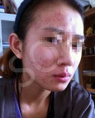 治好痘痘之后 我卸载了美颜相机