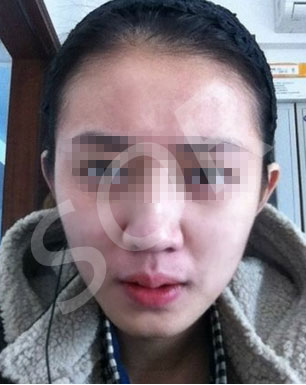 治好痘痘之后 我卸载了美颜相机