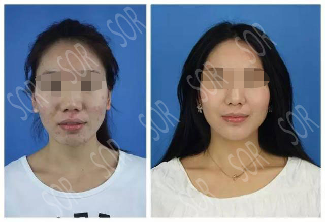 为了业绩长了满脸痘痘怎么办