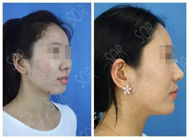 为了业绩长了满脸痘痘怎么办