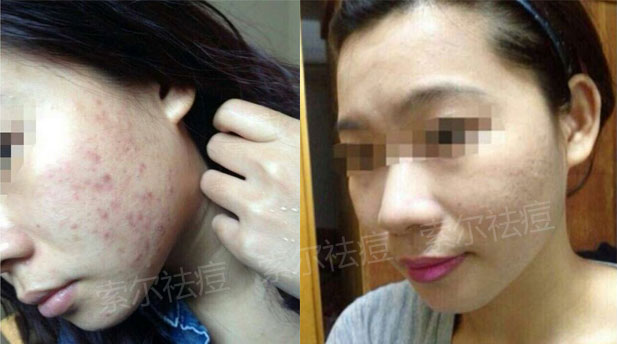 脸颊长痘让我自卑 幸好有索尔祛痘拯救我
