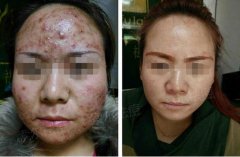 额头满是痘痘 我连出门的勇气都没有