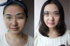 多年的长痘历史终于在这里终结了