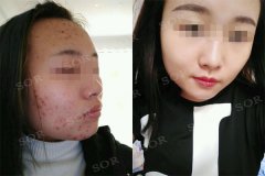 痘痘净 越来越自信！