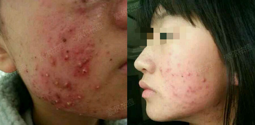 上大学前我终于摆脱了痘痘