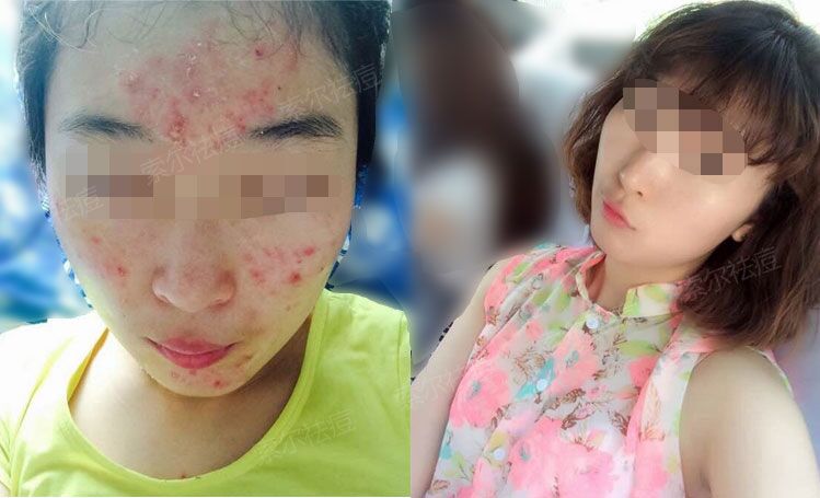 因为痘痘我从女神变成了路人甲