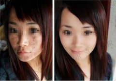 痘来痘去还是斗不过SOR啊