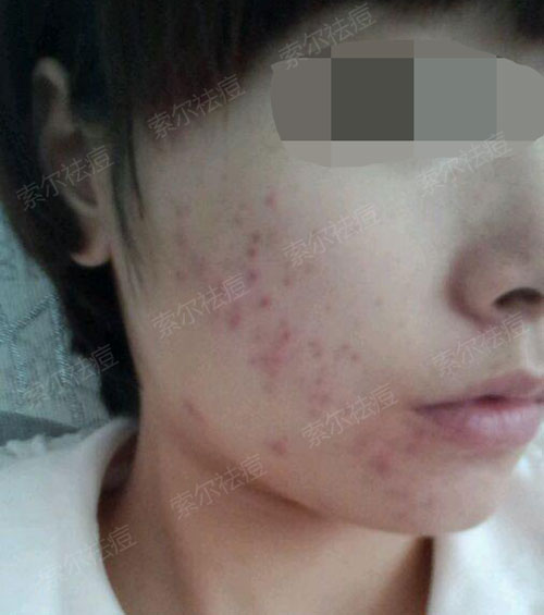 美好的大学生活不能毁在痘痘上