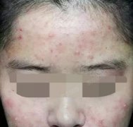 闺蜜一招治好了我多年痘痘