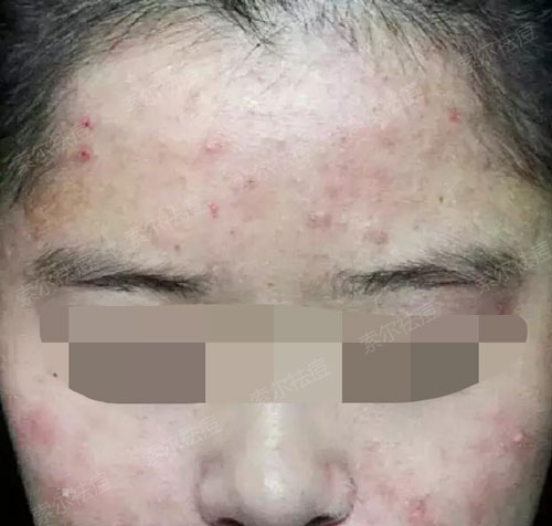 闺蜜一招治好了我多年痘痘