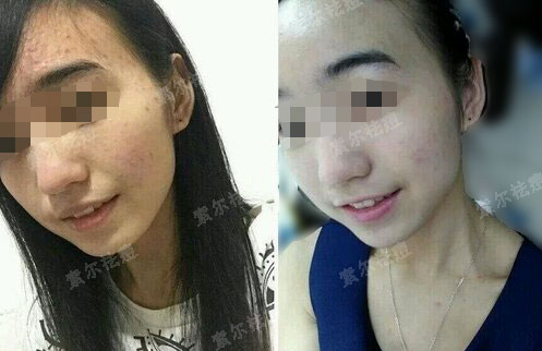 “战痘”也分三六九等？