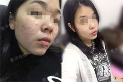 索尔祛痘打开了我的“心灵之窗”