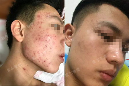 战痘男孩升职记
