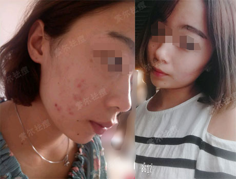 满脸青春痘 爱吃火锅也是错