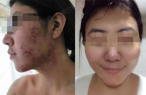 爱吃烧烤的我惹痘上身了