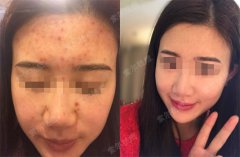 甩掉痘痘　重新焕发活力业绩杠杠