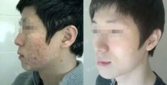 脸上痘痘遍布 可不能放任不顾