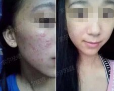 不忌口吃出满脸痘痘怎么办