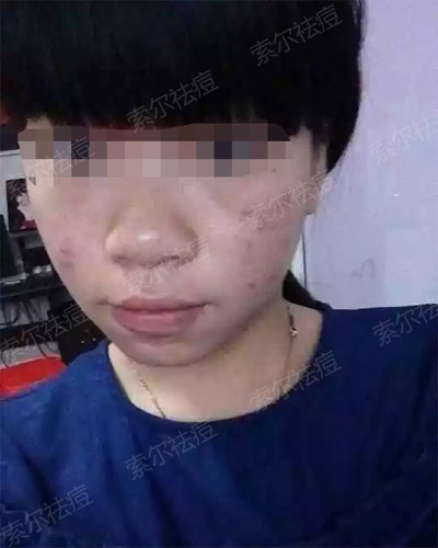 一个吃货的辛酸祛痘史