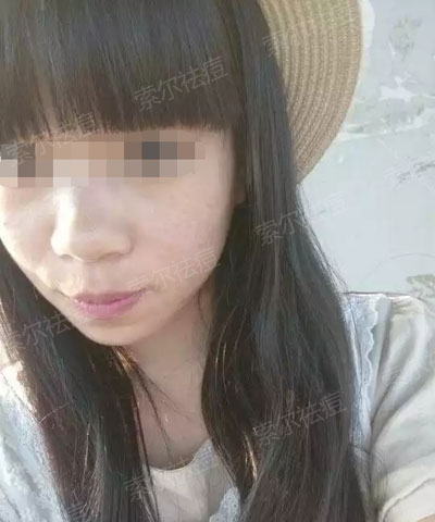 一个吃货的辛酸祛痘史