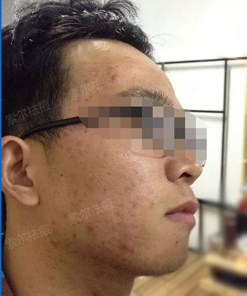 亲测有效 战痘多年的经验之谈