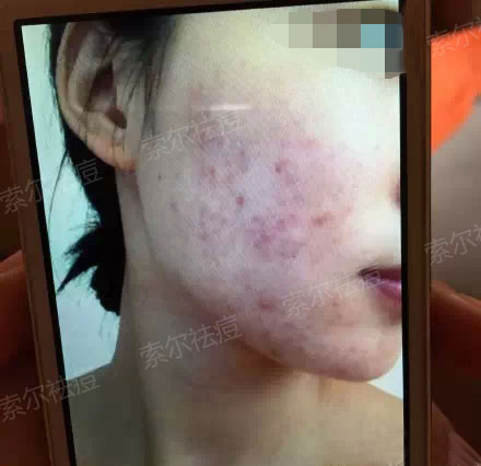 因为它，我结束了长痘的悲催岁月