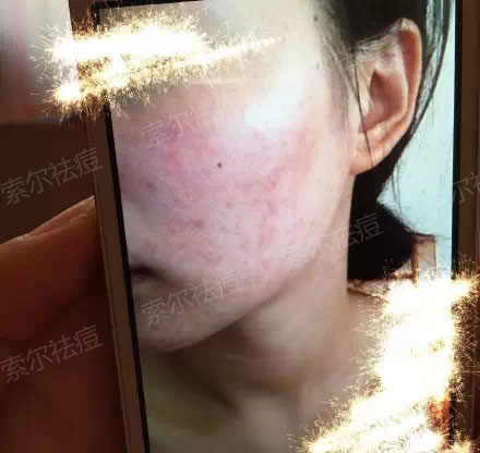 因为它，我结束了长痘的悲催岁月