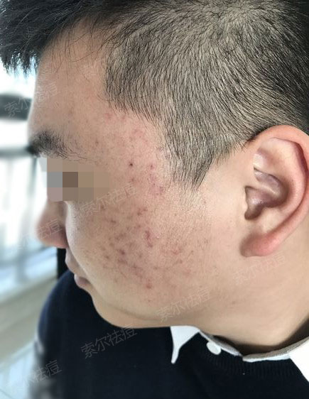 脸颊长痘 再努力做业绩也是白搭