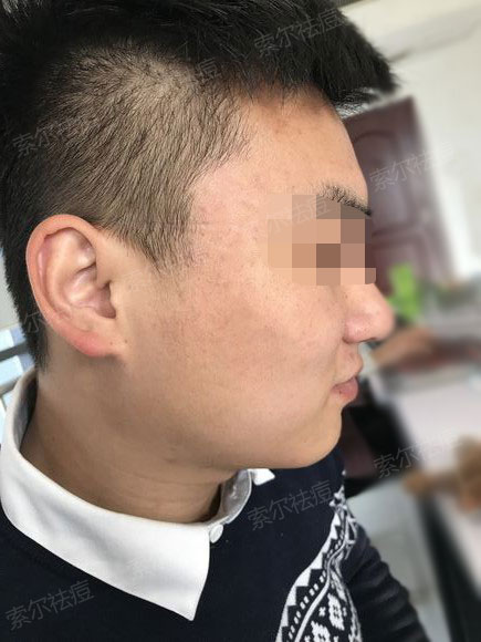 脸颊长痘 再努力做业绩也是白搭