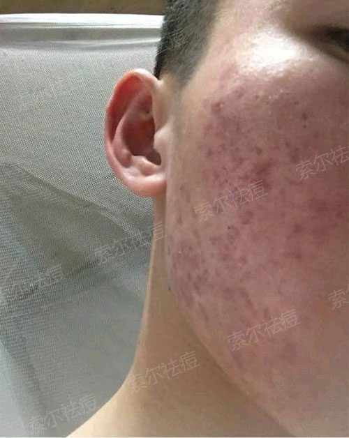 脸颊反复长痘 花费三年终于找到祛痘方法