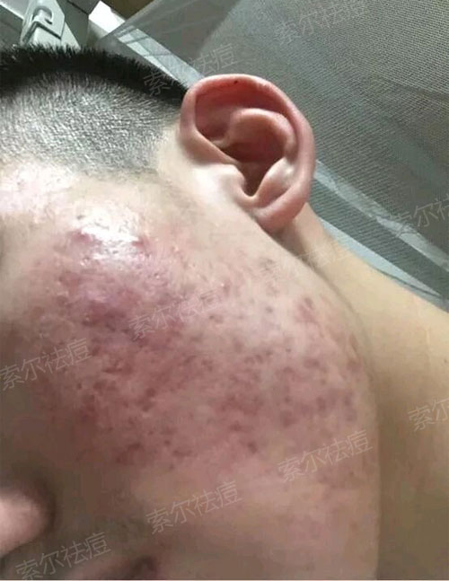 脸颊反复长痘 花费三年终于找到祛痘方法