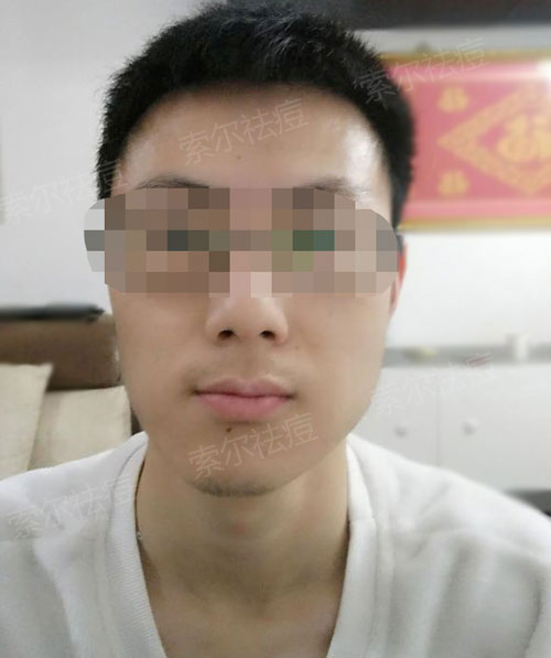 脸颊反复长痘 花费三年终于找到祛痘方法