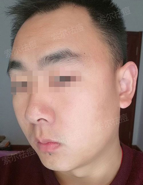 反复长痘好多年 快来看我的曲折祛痘史